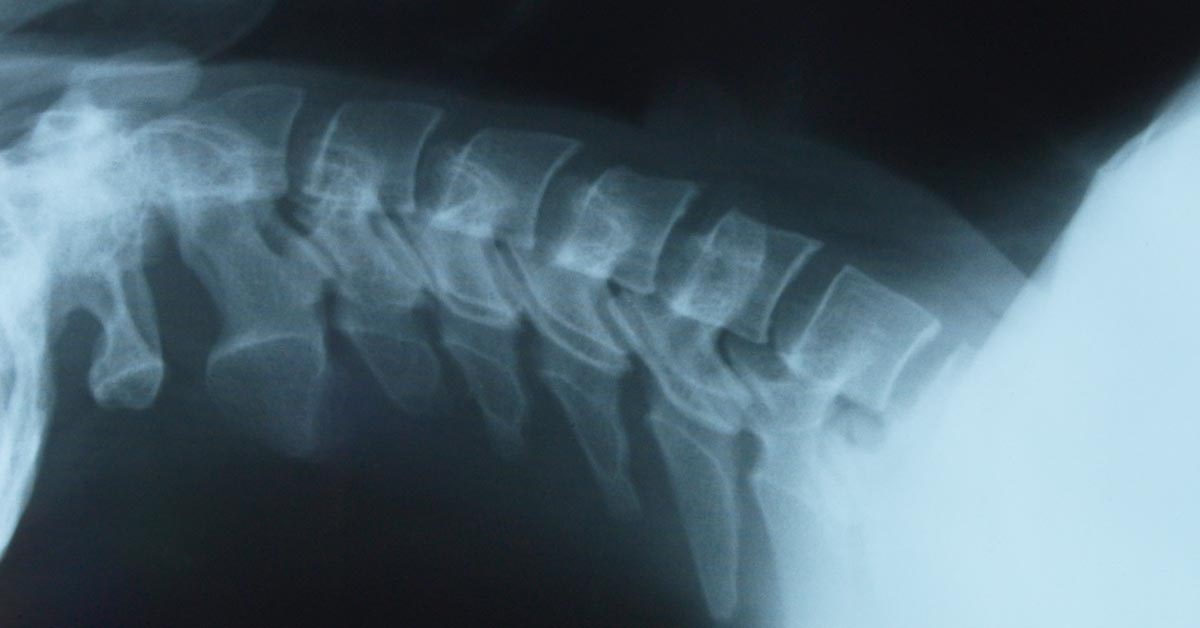 Yakima Back Pain Treatment without Surgery